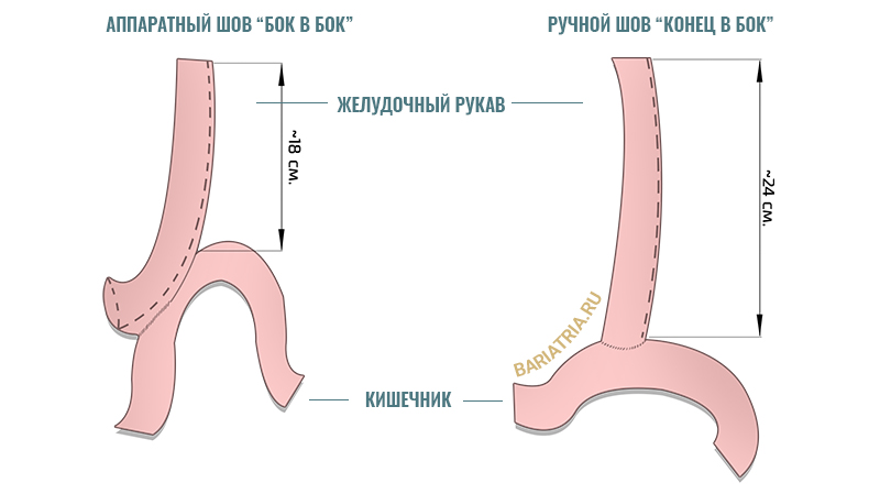Желудочно кишечный анастомоз при мини шунтировании желудка